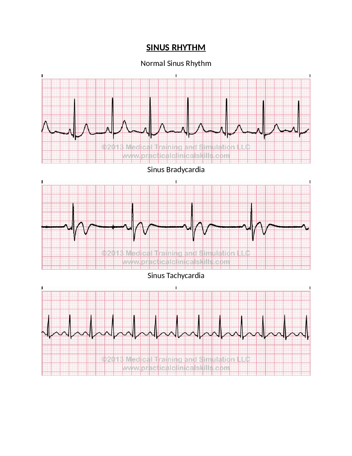 Preview image for Coronary Assignment Sinus Rhythm Analysis